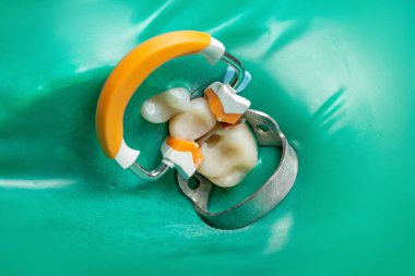 Diş hekimliği, bakıcılık tedavisi. Kauçuk barajlı ağız boşluğu, matris tutucu ve klemp, yakın plan..