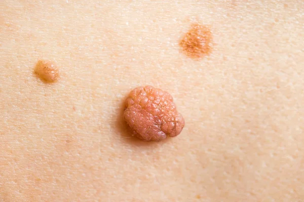 Γυναίκα Σημάδι Στην Πλάτη Της Δέρμα Ετικέτες Αφαίρεση Αισθητική Χειρουργική — Φωτογραφία Αρχείου