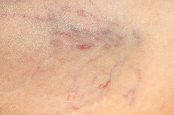 Kavram Örümcek Damarlar Yakından Görmek Kadın Bacak Varisli Damarlar — Stok fotoğraf