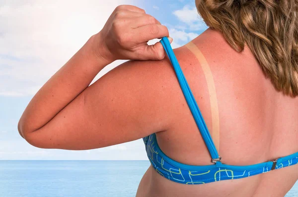 Young Woman Red Sunburned Shoulder Sunburn Concept — Stock Photo, Image