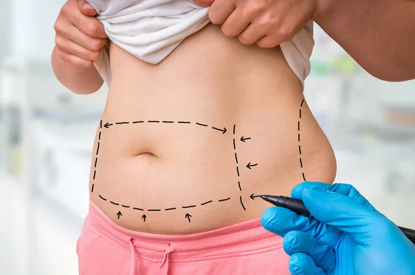 Plastic Surgery Doctor Draw Lines Marker Patient Belly Clinic — Stock Photo, Image