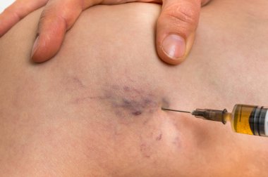 Örümcek damarlar enjeksiyon şırınga - varis kavramı ile kadın bacak üzerinde