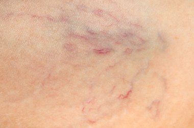 Kavram örümcek damarlar yakından görmek kadın bacak - varisli damarlar