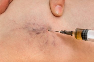Örümcek damarlar enjeksiyon şırınga - varis kavramı ile kadın bacak üzerinde