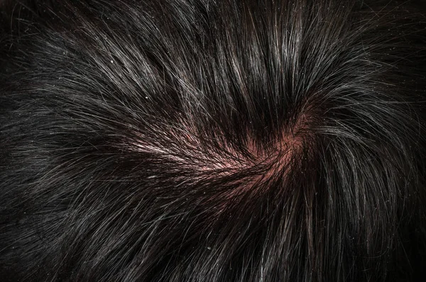 Vista Cerca Del Cabello Hombre Con Caspa Concepto Psoriasis — Foto de Stock