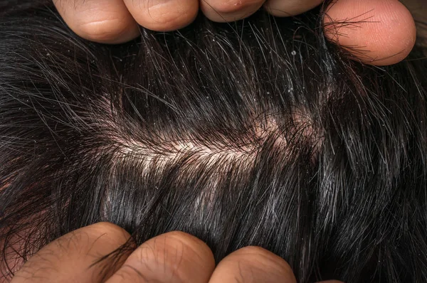 Крупный План Волос Человека Перхоти Концепция Псориаза — стоковое фото