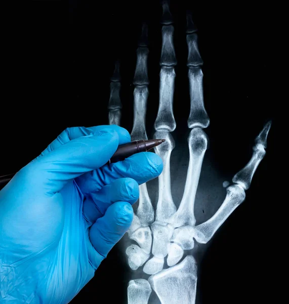 Raios Mão Humana Com Mão Médico Luva Conceito Imagem Raios — Fotografia de Stock