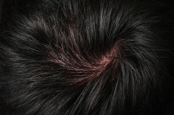 Closeup View Hair Man Dandruff Psoriasis Concept — Stock Photo, Image