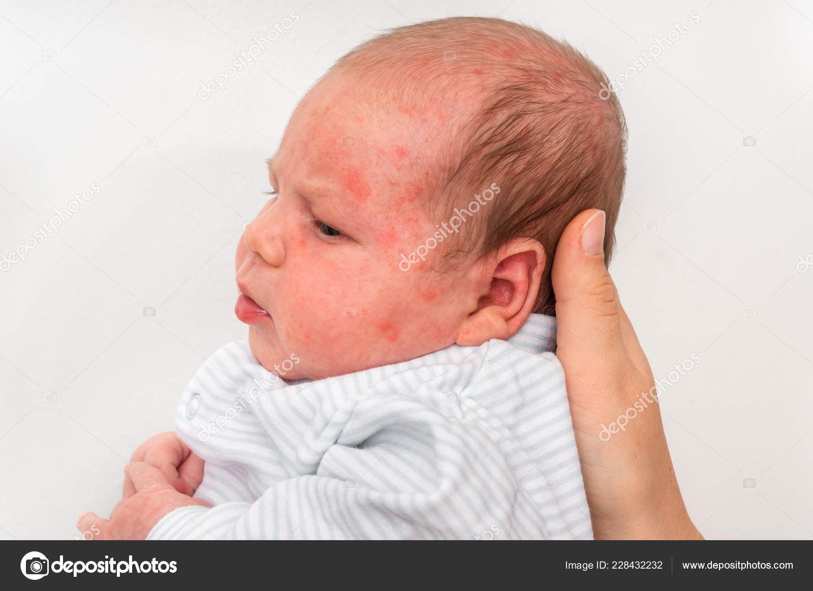 Little Newborn Baby Skin Rash Allergic Reaction Birth Body Trying