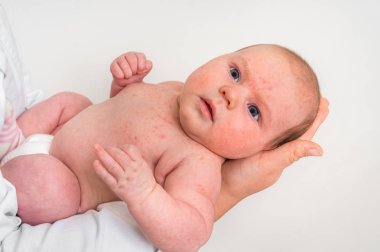 Yeni doğan bebek ile deri döküntüsü. Doğumdan, vücut detoxify çalışıyor sonra alerjik reaksiyon.
