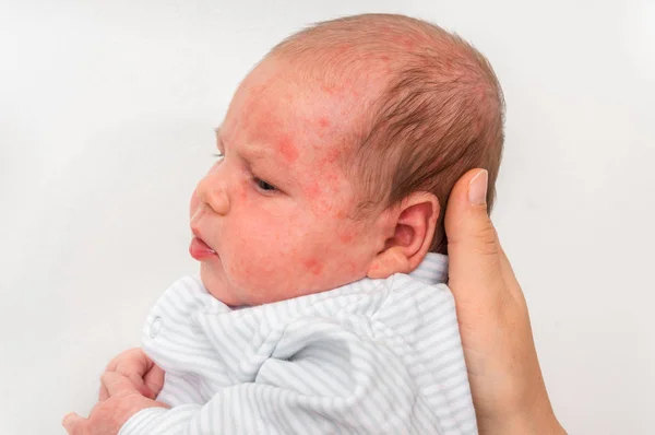 患有皮疹的小新生婴儿 出生后过敏反应 身体试图排毒 — 图库照片