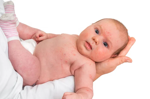 Little Newborn Baby Skin Rash Allergic Reaction Birth Body Trying — Stock Photo, Image