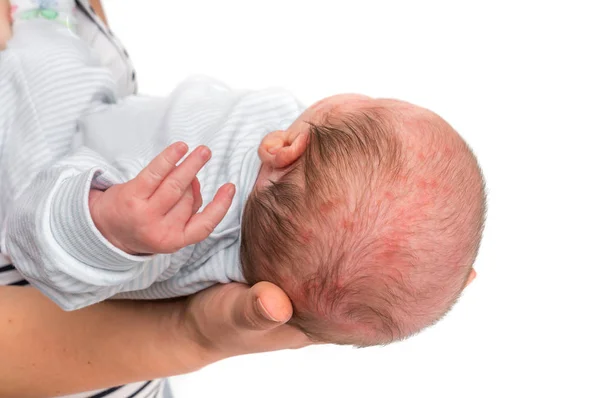 Lite Nyfødt Barn Med Hudutslett Allergisk Reaksjon Etter Fødselen Forsøk – stockfoto