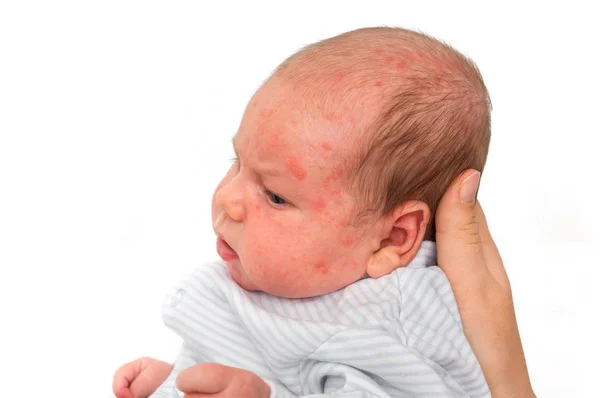 Little Newborn Baby Skin Rash Allergic Reaction Birth Body Trying — Stock Photo, Image