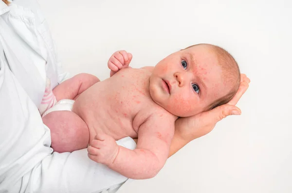 Lilla Nyfödda Bebis Med Hudutslag Allergisk Reaktion Efter Födseln Kroppen — Stockfoto