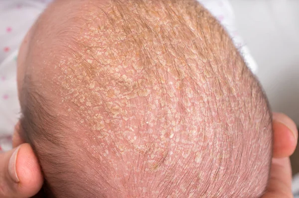 Kleine Pasgeboren Baby Met Psoriasis Roos Het Haar — Stockfoto