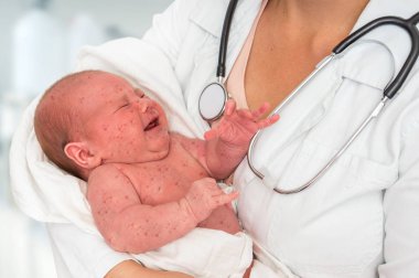 Doctor with stethoscope holding a newborn baby which is sick rubella or measles clipart