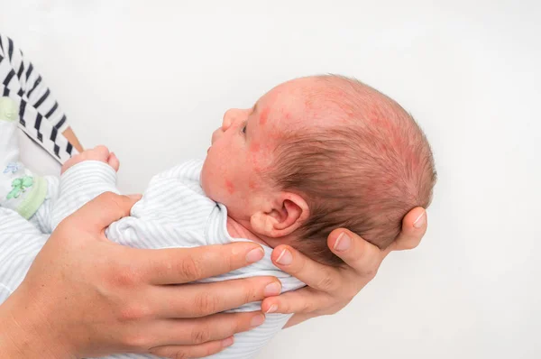Little Newborn Baby Skin Rash Allergic Reaction Birth Body Trying — Stock Photo, Image