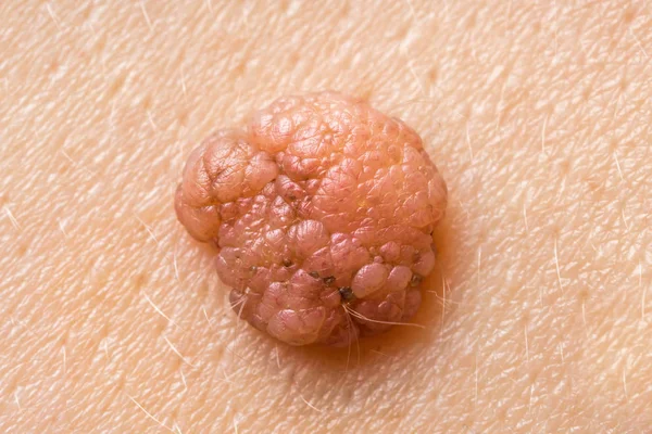 Makrofotografie von Maulwürfen auf menschlicher Haut — Stockfoto
