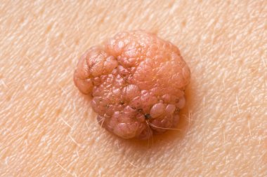 Köstebek bir insan derisi üzerinde makro fotoğrafçılık