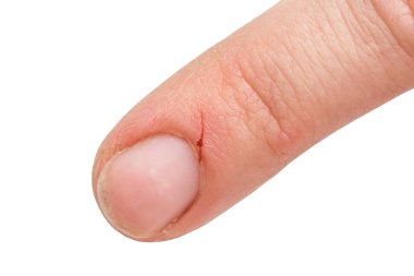 Kan mutfak bıçağıyla gelen yaralı parmak