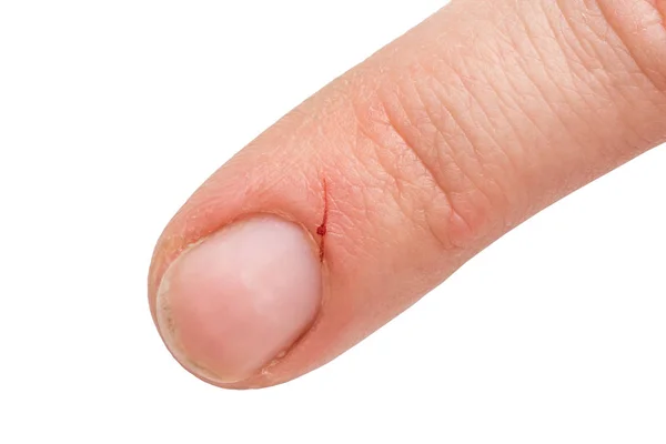 Injured finger from a kitchen knife with blood — Stock Photo, Image
