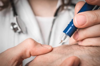Doktor bir kene cımbız ile hasta elden çıkarma.