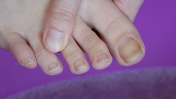 Mujer overgrown largo unclipped uñas de los pies — Vídeos de Stock
