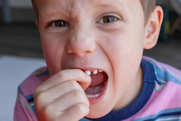 赤ちゃんの歯を除去するプロセス 勇敢な強い少年は自分の歯を抜く 健康な乳歯の喪失 — ストック写真