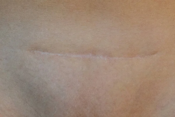 Cicatriz Parto Cesáreo — Fotografia de Stock
