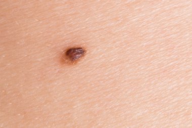 Ten yakın çekim üzerinde büyük köstebek. Anormal köstebek.