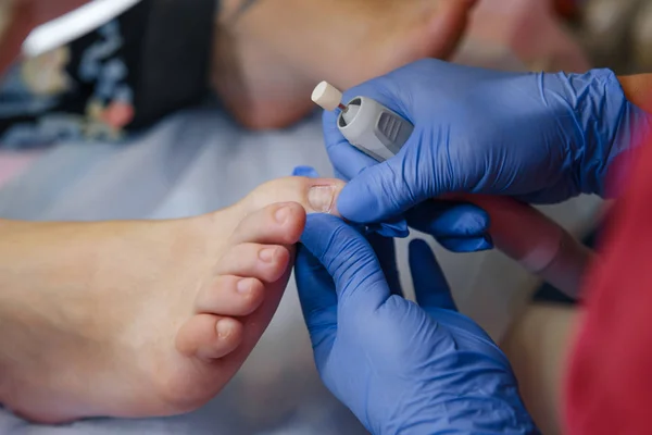 Podology treatment. Podiatrist treating toenail fungus. Doctor removes calluses, corns and treats ingrown nail. Hardware manicure. Health, body care concept. Selective focus.