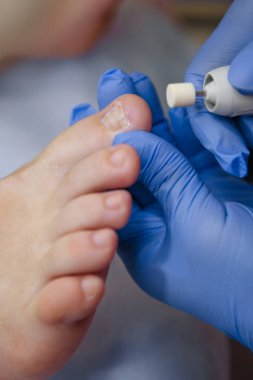 Podology tedavi. Ayak hastalıkları uzmanı ayak davranır. Podiatry doktor veya dermatolog muamele etmek