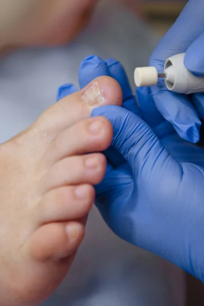 Tratamiento podológico. El podólogo trata el pie. Médico de podología o dermatólogo trata — Foto de Stock