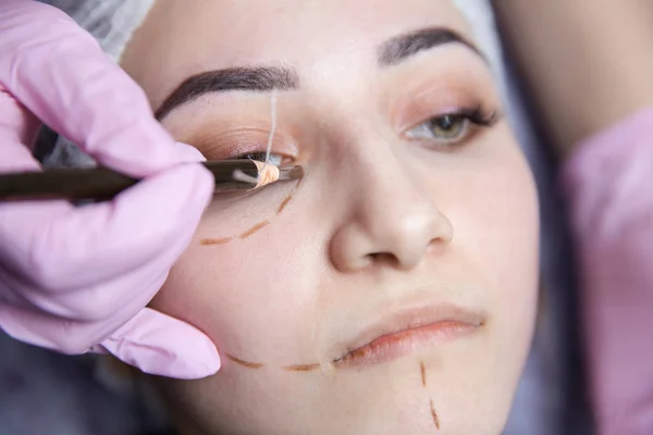 Preparazione per la chirurgia plastica. Giovane modella in clinica con linee di perforazione sul viso . — Foto Stock