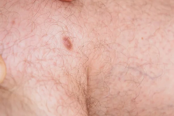 Sağlık ve sağlık - bacağında dermato fibroma fotoğrafı