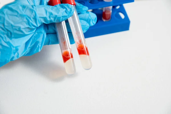 Doctor Pulls Out Tube Second Group Blood Tripod — Stock Photo, Image