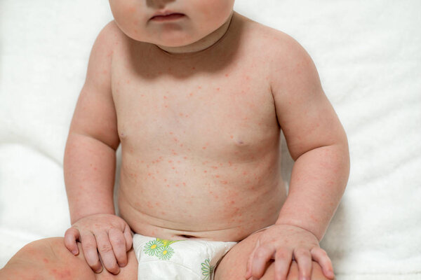 Close-up of naked body of child with pimples of chicken pox. pimples on the body of child with chickenpox.