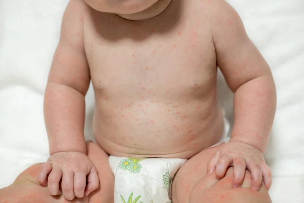 Yakın Çekim Çocuk Çıplak Vücut Sivilce Tavuk Pox Ile Çiçeği — Stok fotoğraf