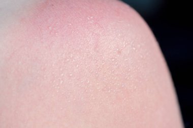 Cilt Bakımı kavramı. Yakışıklı adam güneş yanığı var ve omzunda bronzlaşma hatları var. Deri onun yanık derisi kapalı sloughs. Bu Melanoma nedenidir. Omzunda yanan bir acı var. Acı çekiyor.