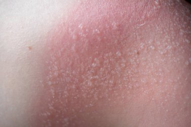 Cilt Bakımı kavramı. Yakışıklı adam güneş yanığı var ve omzunda bronzlaşma hatları var. Deri onun yanık derisi kapalı sloughs. Bu Melanoma nedenidir. Omzunda yanan bir acı var. Acı çekiyor.