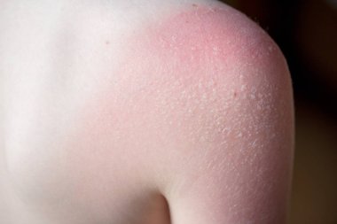 Cilt Bakımı kavramı. Yakışıklı adam güneş yanığı var ve omzunda bronzlaşma hatları var. Deri onun yanık derisi kapalı sloughs. Bu Melanoma nedenidir. Omzunda yanan bir acı var. Acı çekiyor.