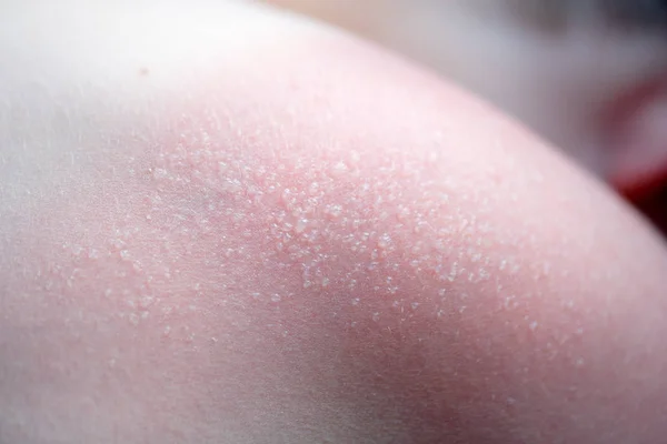 Concepto de cuidado de la piel. Un tipo guapo se quemó el sol y se puso bronceado en el hombro. La piel se desprende de su piel quemada. Es la causa del melanoma. Tiene un dolor ardiente en el hombro. Él sufre. — Foto de Stock