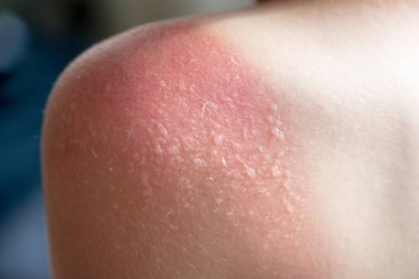 Cilt Bakımı kavramı. Yakışıklı adam güneş yanığı var ve omzunda bronzlaşma hatları var. Deri onun yanık derisi kapalı sloughs. Bu Melanoma nedenidir. Omzunda yanan bir acı var. Acı çekiyor.