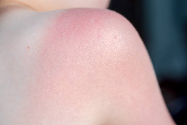 Cilt Bakımı kavramı. Yakışıklı adam güneş yanığı var ve omzunda bronzlaşma hatları var. Deri onun yanık derisi kapalı sloughs. Bu Melanoma nedenidir. Omzunda yanan bir acı var. Acı çekiyor.