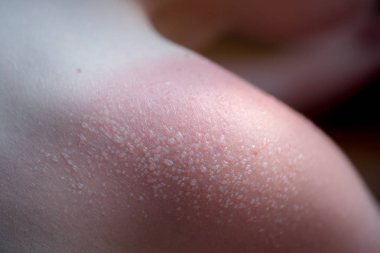 Cilt Bakımı kavramı. Yakışıklı adam güneş yanığı var ve omzunda bronzlaşma hatları var. Deri onun yanık derisi kapalı sloughs. Bu Melanoma nedenidir. Omzunda yanan bir acı var. Acı çekiyor.