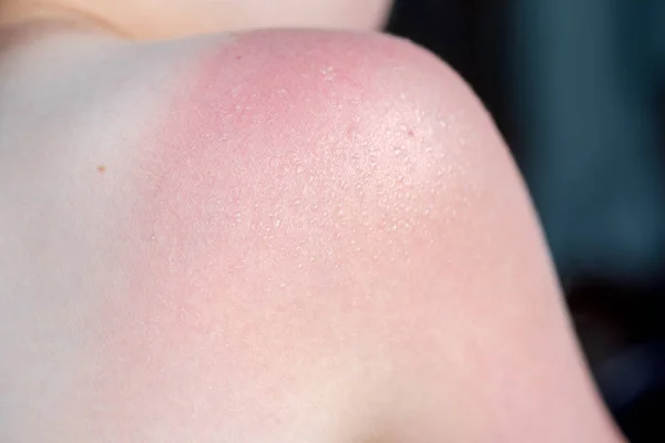 Concepto de cuidado de la piel. Un tipo guapo se quemó el sol y se puso bronceado en el hombro. La piel se desprende de su piel quemada. Es la causa del melanoma. Tiene un dolor ardiente en el hombro. Él sufre. — Foto de Stock