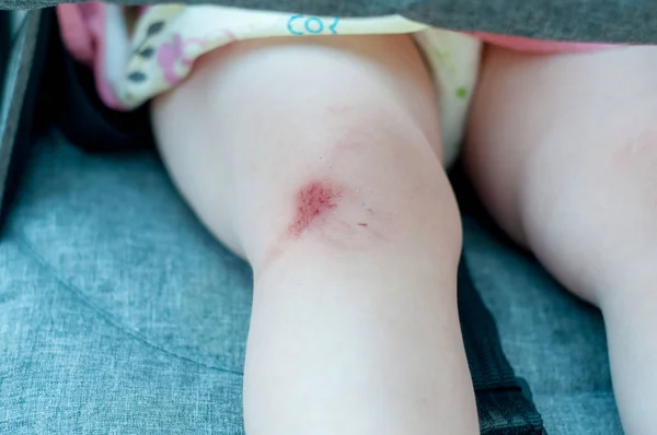 Θαμπάδα εικόνα της φρέσκια πληγή στο γόνατο, φρέσκο τραύμα στο γόνατο μώλωπας με κάποια μικρή πέτρα και σκόνη αριστερά από ατύχημα με ποδήλατο. — Φωτογραφία Αρχείου