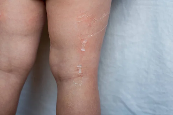 Κατεστραμμένο Δέρμα Του Παιδιού Χύνεται Κόλλα Στα Πόδια Και Χέρια — Φωτογραφία Αρχείου
