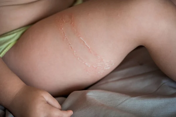 Çocuğun Derisi Zarar Görmüş Bacaklarına Kollarına Tutkal Dökülmüş Bacağından Yaralanmış — Stok fotoğraf